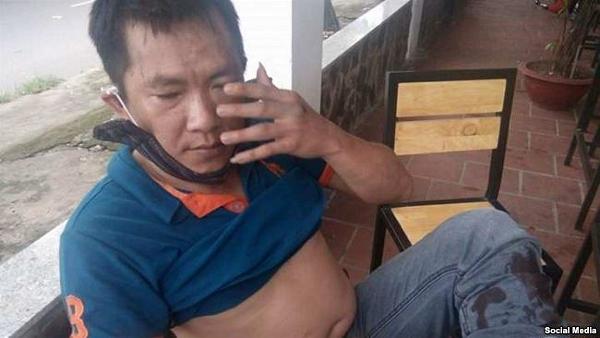 Anh Huỳnh Anh Tuấn sau khi bị đánh ngày 25-6-2017 (Facebook Huu Den)